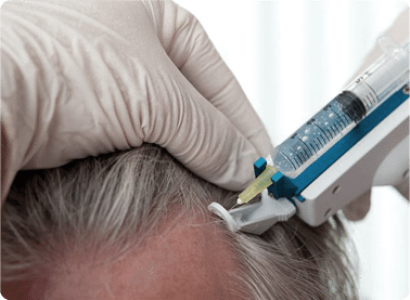 Mesotherapy emerging treatment for hair loss