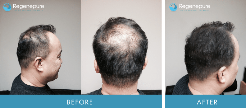 Nizoral shampoo hair loss results doesnt work