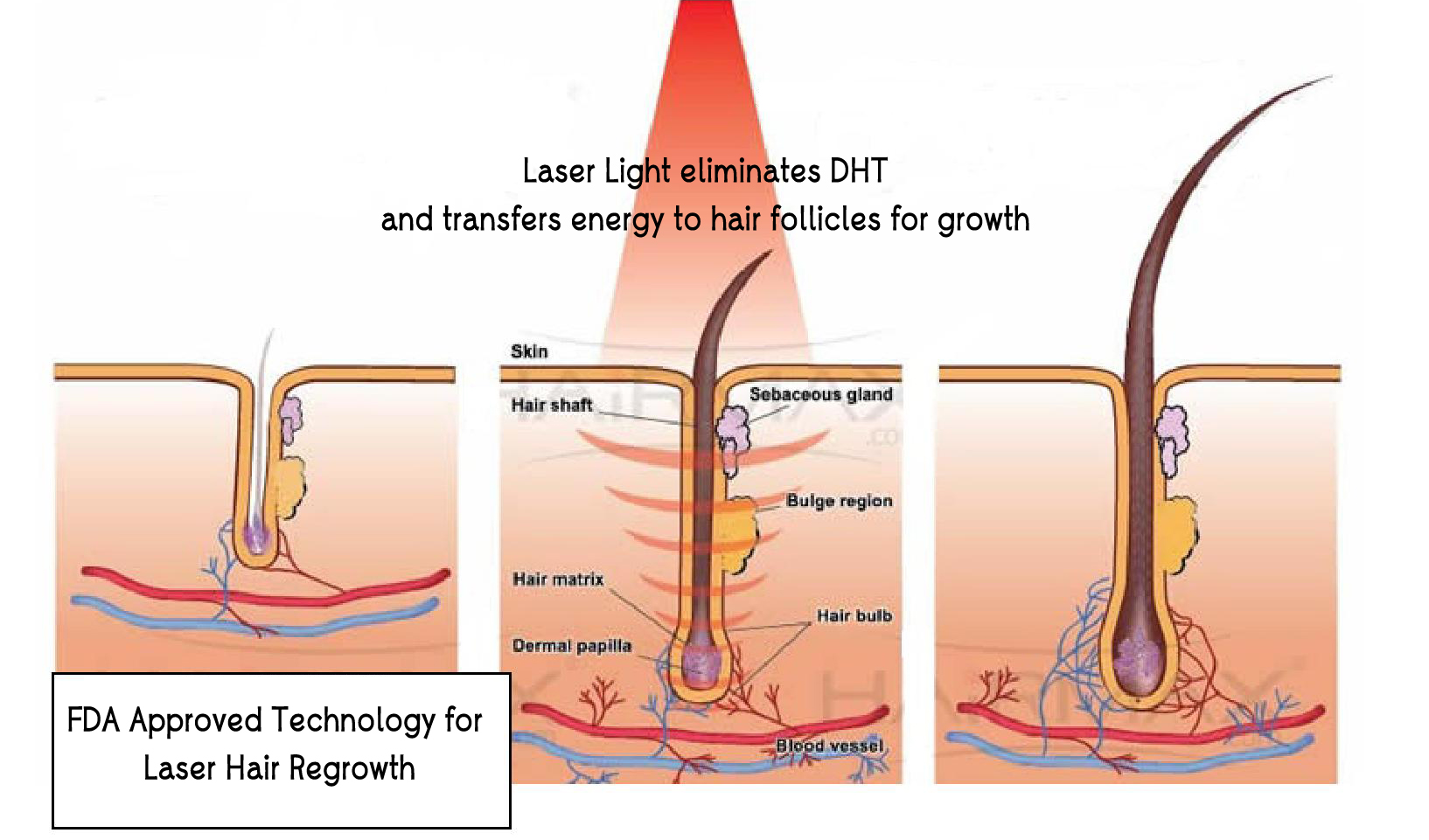 laser-hair-growth-visual