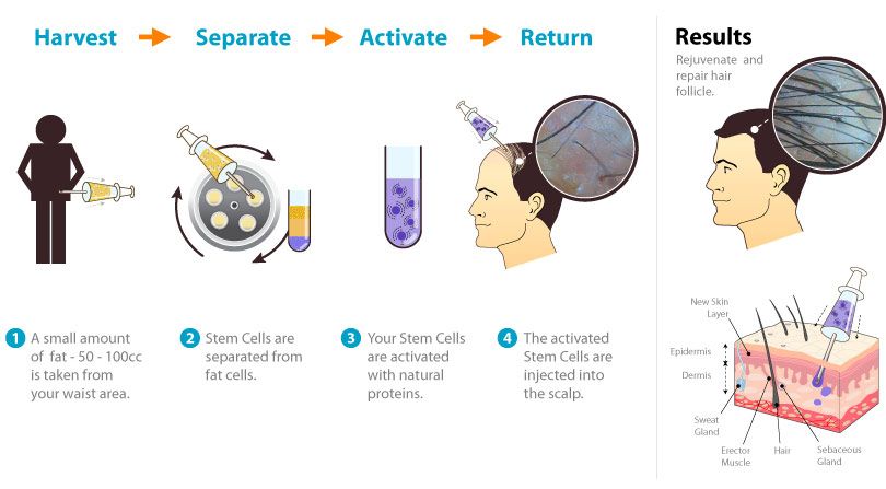 use-of-stem-cells-grow-hair-1