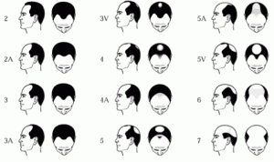 Assess hair loss in men