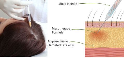 Mesotherapy works for hair loss