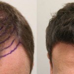 proven effect of minoxidil in post hair transplant