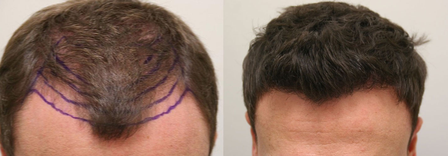 proven effect of minoxidil in post hair transplant