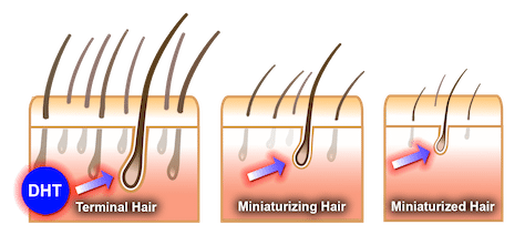 DHT Hair Loss Stages