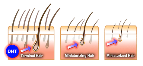 DHT hair loss. What is DHT & how it causes hair loss