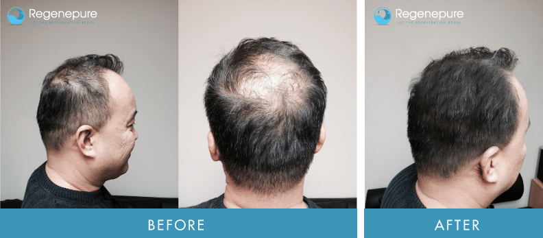 Male with hair growth by minoxidil treatment